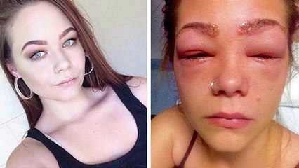 She almost lost her sight after trying to dye her eyebrows