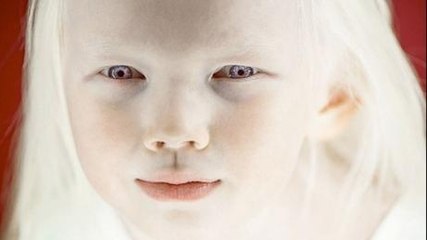 This little girl has become famous thanks to her unique look