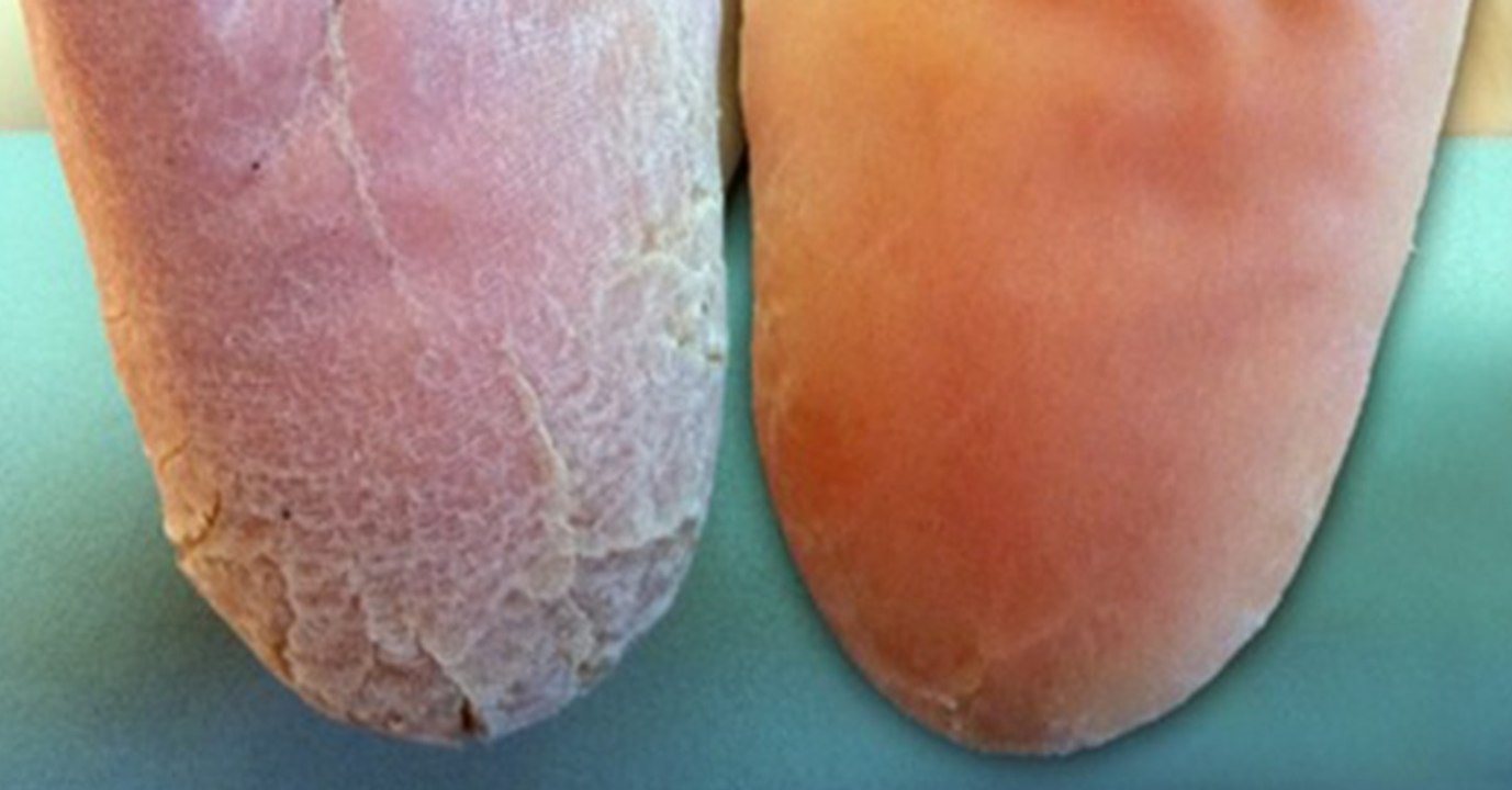 Gegen Hornhaut an den Füßen: Diese einfachen Hausmittel wirken Wunder