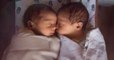 Exceptionally rare 'semi identical' twin babies have bewildered doctors