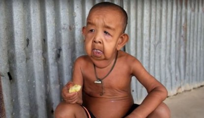 "Benjamin Button aus Bangladesh": Dieser kleine Junge sieht aus wie ein 80-Jähriger