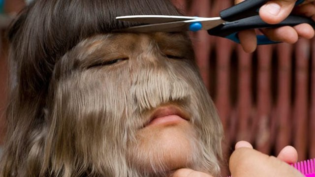 So sieht das haarigste Mädchen der Welt heute als Jugendliche aus