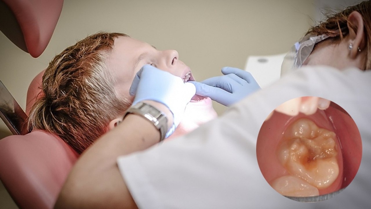 Kaputte Zähne bei Kindern in Deutschland immer häufiger: Jetzt kommt ein schlimmer Verdacht auf!