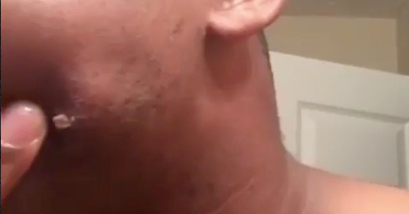 Mann will Pickel mit Pinzette entfernen: Was herauskommt, ist einfach ekelhaft