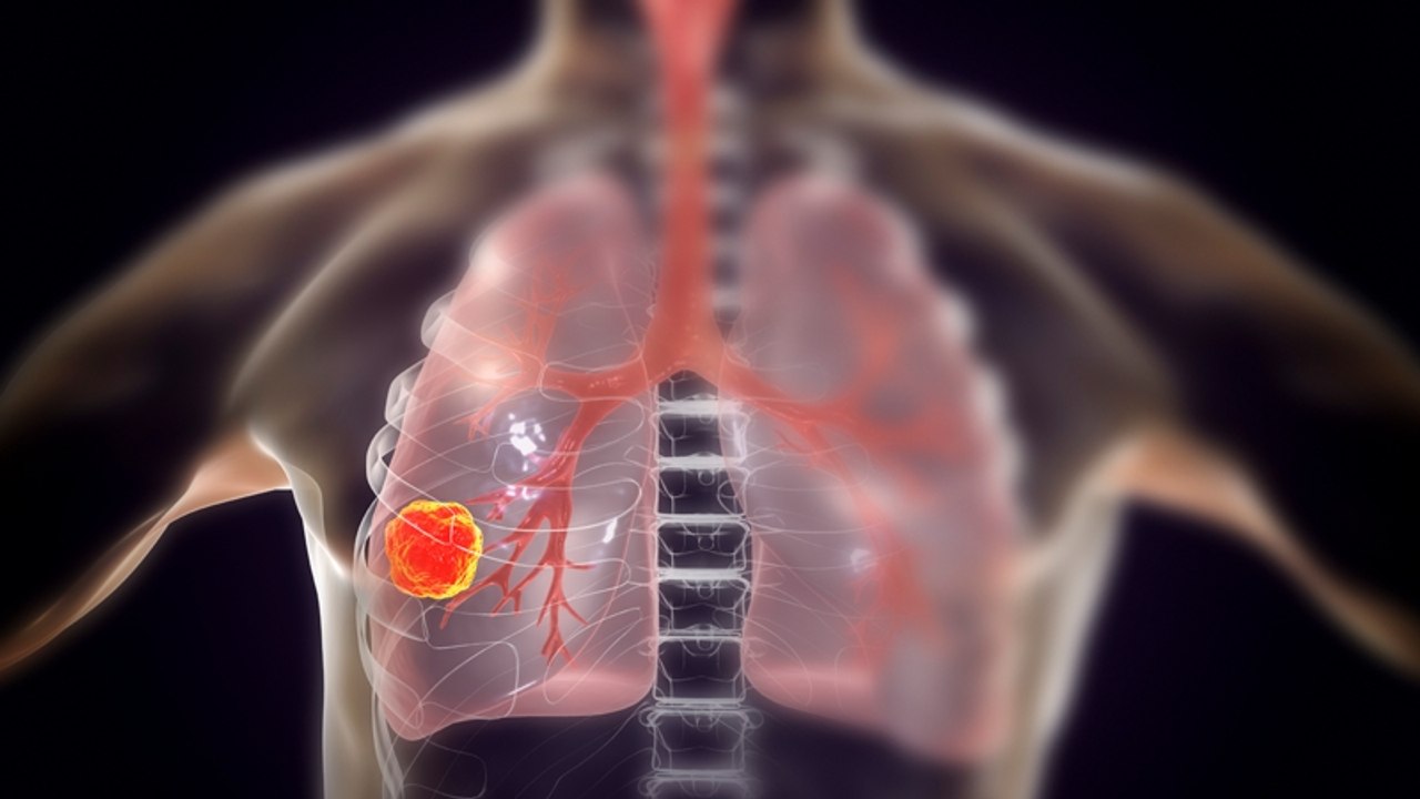 Forschende warnen: Ein Lebensmittel regt das Wachstum von Krebszellen an