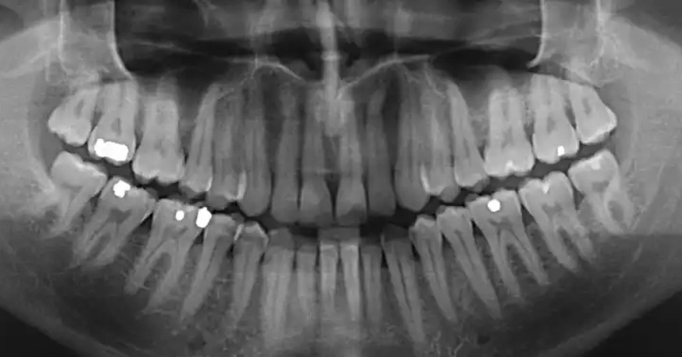 'Porphyromonas gingivalis': Das Bakterium im Mund könnte der Auslöser einer schlimmen Krankheit sein
