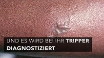 Sie glaubt, sie hat einen Pickel: Ihr Arzt stellt beunruhigende Diagnose