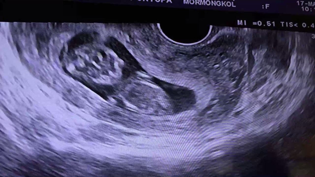 Ungewöhnliche Geburt: Neugeborenes trägt eigenen Zwilling im Bauch