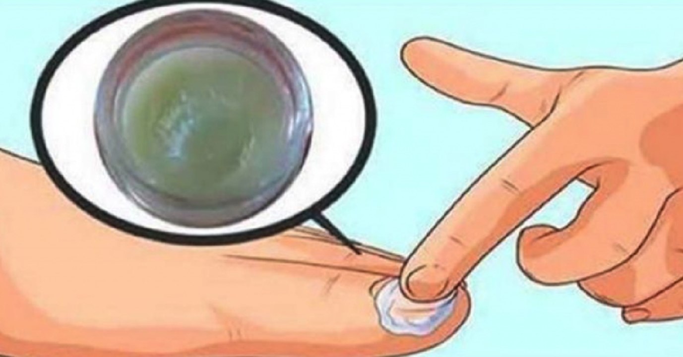 Das sind die besten Hausmittel gegen Nagelpilz