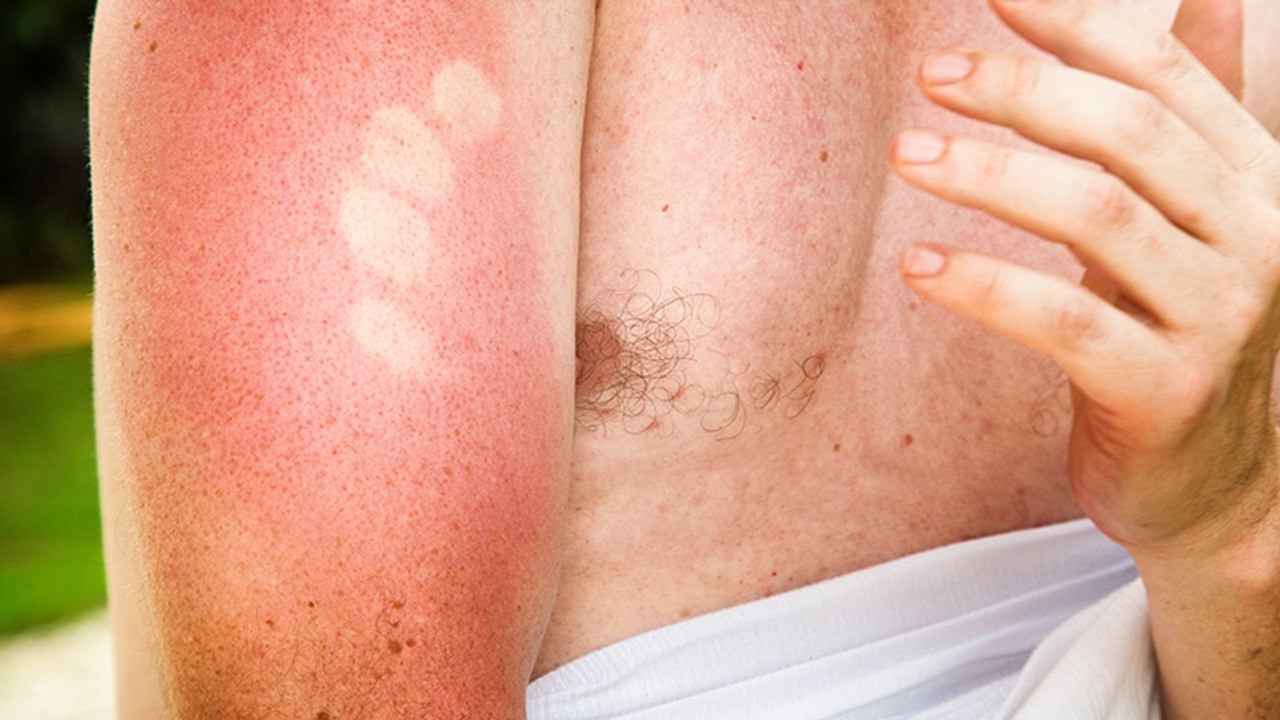 Männerprodukt lindert sonnenbrand in sekundenschnelle