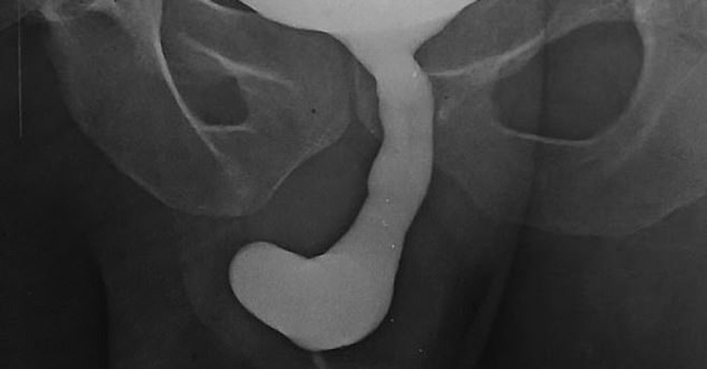 Mann wird wegen Krebs am Hals operiert, dann fällt plötzlich sein Geschlechtsteil ab!