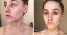 This Woman Stopped Washing Her Face For Six Months And Cured Her Acne