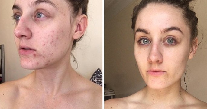 This Woman Stopped Washing Her Face For Six Months And Cured Her Acne