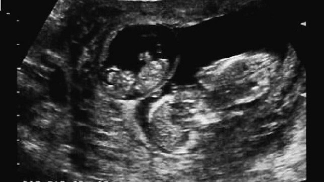 Superfötation: Jessica Allen bekommt zwei Kinder auf einmal - doch es sind keine Zwillinge