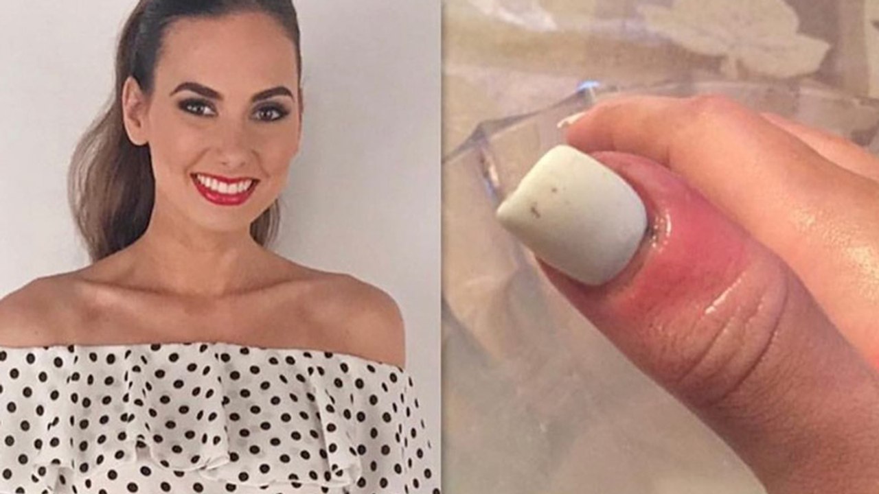 'Miss Illinois': Als ihr Daumen rot anschwillt, geht sie zum Arzt - die Diagnose ist erschütternd