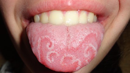 Santé : qu'est-ce-que la mystérieuse maladie de la ''langue géographique'' ?