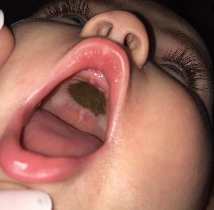 Mutter entdeckt seltsamen Fleck im Mund ihres Babys: Bei der Diagnose bricht sie in Tränen aus