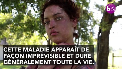 Lupus : symptômes, diagnostic, traitement, qu'est-ce que c'est ?