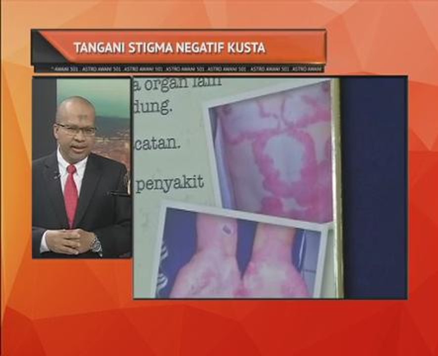 Tangani stigma negatif kusta