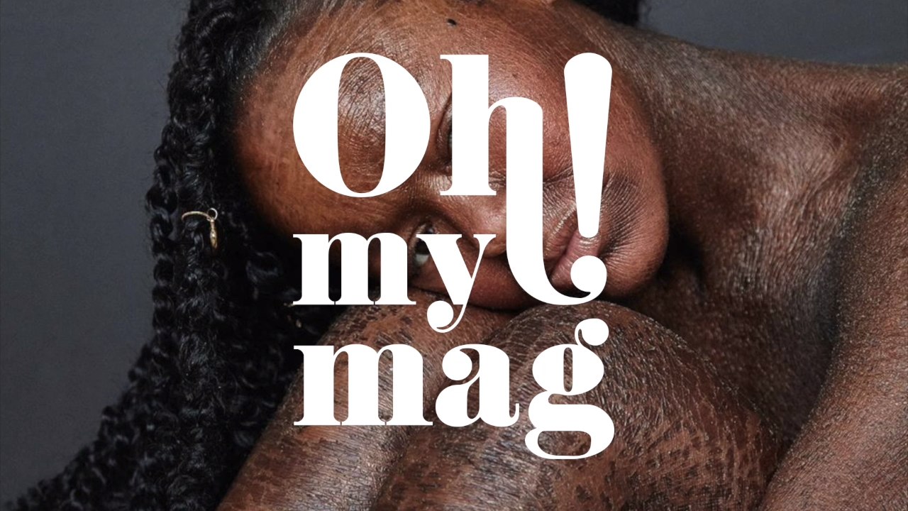 Fischschuppen-Haut: Dieses Model macht aus ihrer Krankheit ihre Stärke