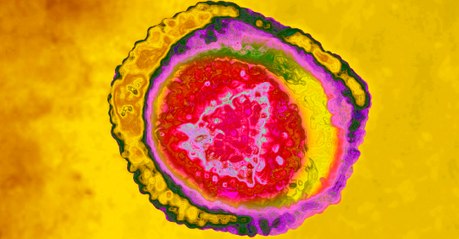 Roséole infantile ou chez l'adulte : contagion, traitement, symptômes, de quoi s'agit-il ?