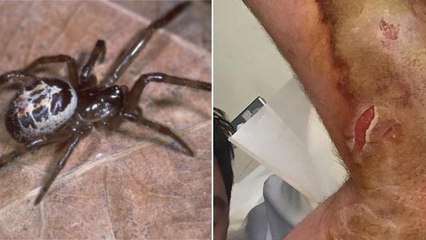 Un homme hospitalisé 10 jours à cause d'une morsure d'araignée