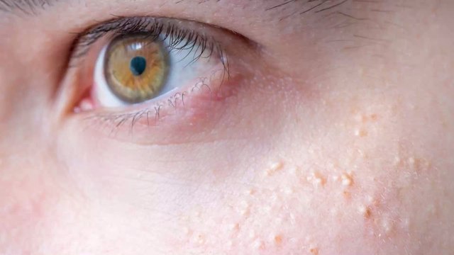 Milia: what causes these small white dots under your eyes?