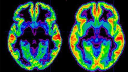 Schizophrénie : définition, symptômes, traitement, causes, qu'est ce que c'est ?