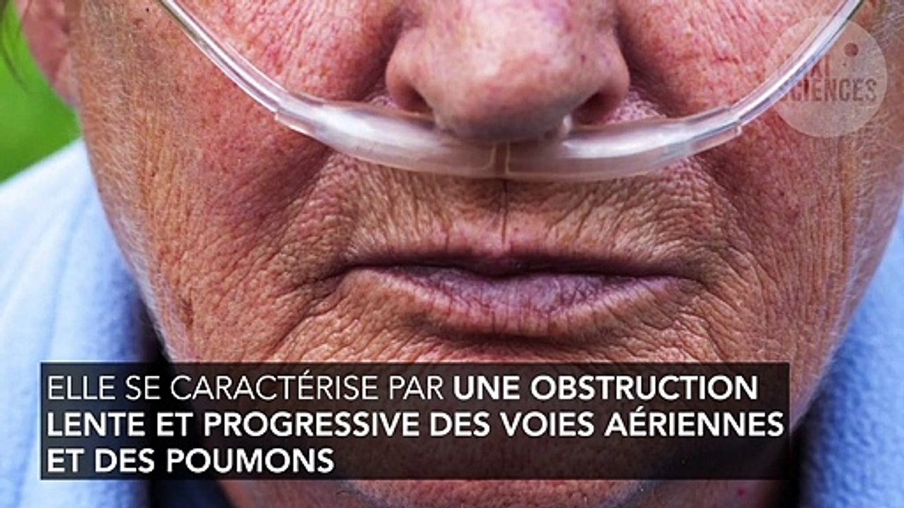 BPCO : définition, symptômes, traitement, stades, de quoi s'agit-il ?