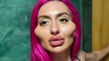 After Injecting Fillers into Her Own Face This Woman Claims She Get's More Romantic Attention Than Ever