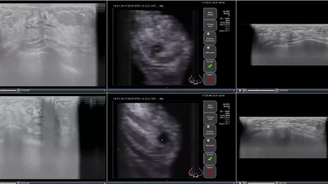 Von Brustkrebs geheilt: Frau erfährt Jahre später, was ihr Arzt wirklich getan hat