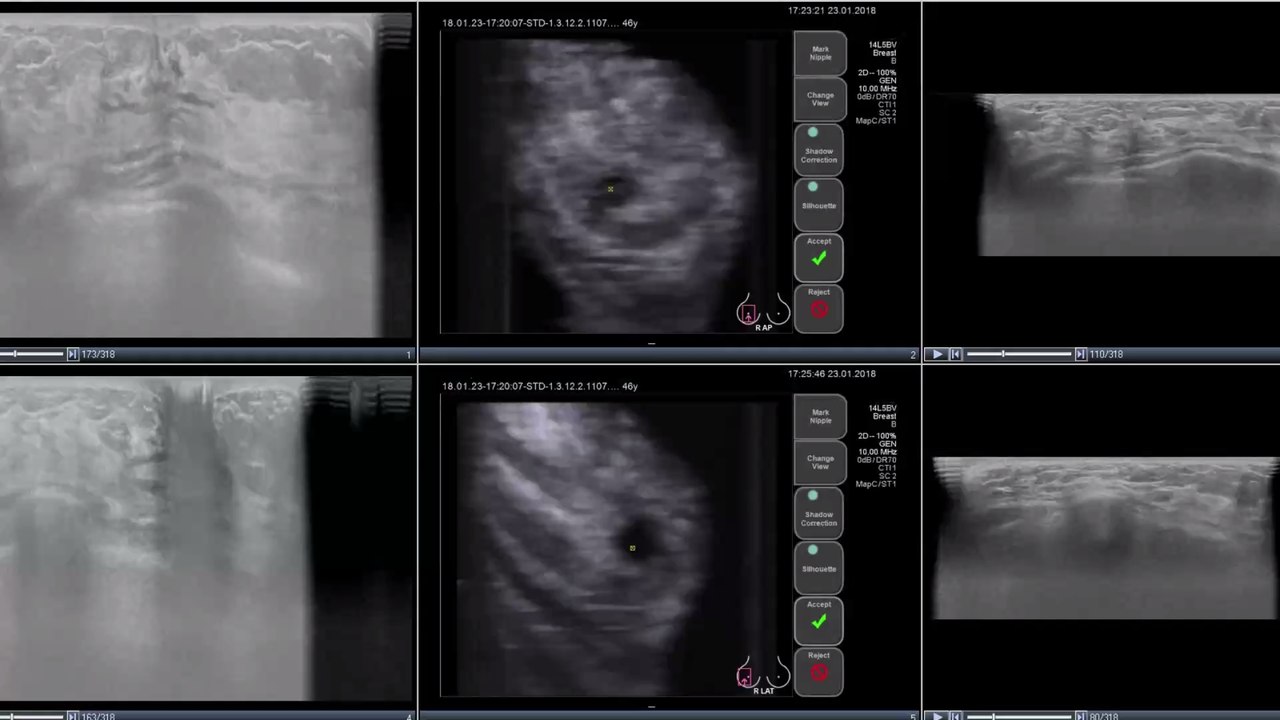 Von Brustkrebs geheilt: Frau erfährt Jahre später, was ihr Arzt wirklich getan hat