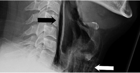 Eternuement : un homme se déchire le pharynx en se retenant d'éternuer