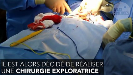 Il a vécu avec une compresse dans le poumon pendant 27 ans