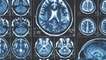 Sciences : Des médecins pensent avoir trouvé de nouveaux organes secrets au centre de notre tête