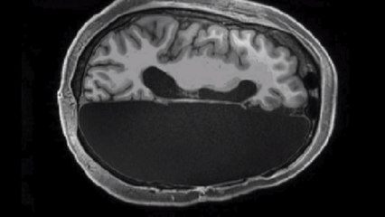 Est-il possible de vivre avec seulement un demi-cerveau ?