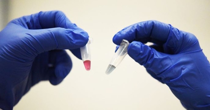 Cancer : Les nanoparticules d'or pour tuer les cellules cancéreuses, une nouvelle technique prometteuse