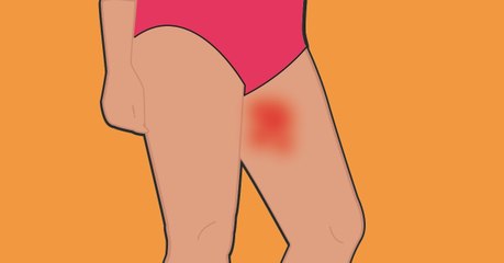 Que faire pour éviter les irritations sur les cuisses pendant l'été ?