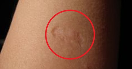 Voici la signification de la petite cicatrice présente sur le bras de certaines personnes !