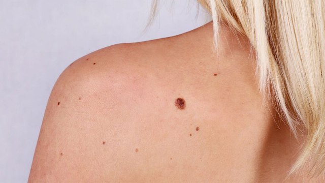 Cancer de la peau : ABCDE, la méthode simple et efficace pour repérer un grain de beauté à risque