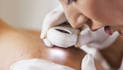 Cet ordinateur peut détecter les cancers de la peau mieux que les médecins