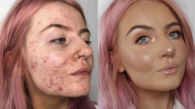 Acné : un avant/après choquant grâce à cette marque de make-up
