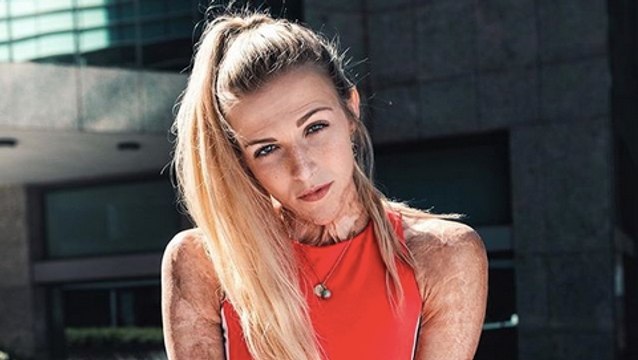 Grande brûlée, la courageuse (et talentueuse) Julie est devenue influenceuse