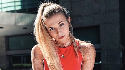 Grande brûlée, la courageuse (et talentueuse) Julie est devenue influenceuse