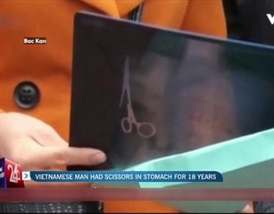 Vietnamese man had scissors in stomach for 18 years