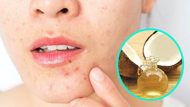 चेहरे पर नारियल तेल लगाने के नुकसान । चेहरे पर नारियल तेल लगाने से क्या होता है । Boldsky