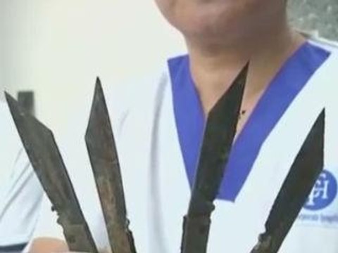 Indian doctors remove 40 knives from man's stomach