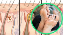 पैर में पसीना आना Hyperhidrosis के Symptoms, जानें क्या है बचाव | Boldsky