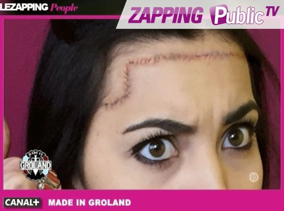 Zapping Public TV n°974 : "Pour éviter tout risque de tumeur, elle a aussi subi une ablation du cerveau" (Made in Groland)