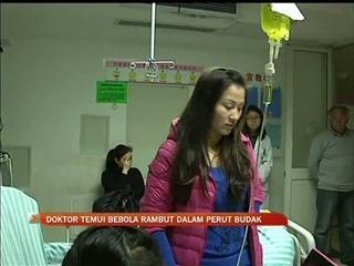 Doktor temui bebola rambut dalam perut budak